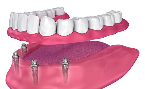 Animated model of dental implant supported denture placement