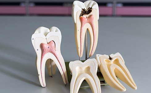 Model of healthy tooth and tooth in need of root canal therapy