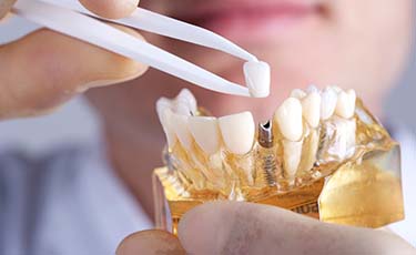 Dentist placing a dental crown on top of a dental implant in a model of the jaw
