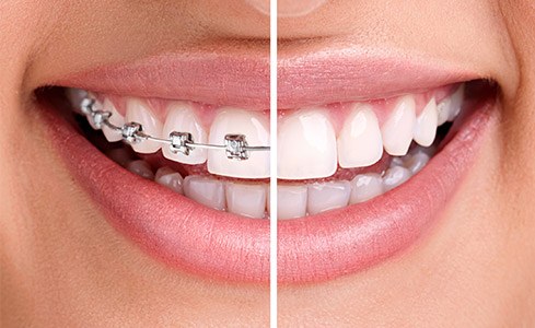 Teeth with traditional braces and teeth with Invisalign