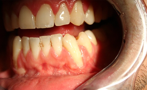 Smile with gum recession before Chao pinhole surgical technique treatment