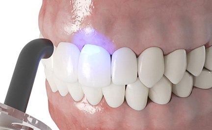 Illustration of curing light being used to harden dental bonding