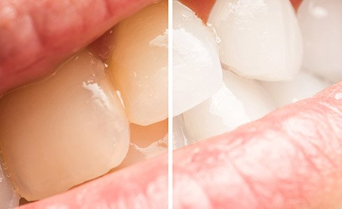 Teeth before and after teeth whitening