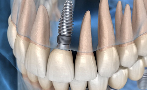 Dental Implants from Celeb Jaws Health