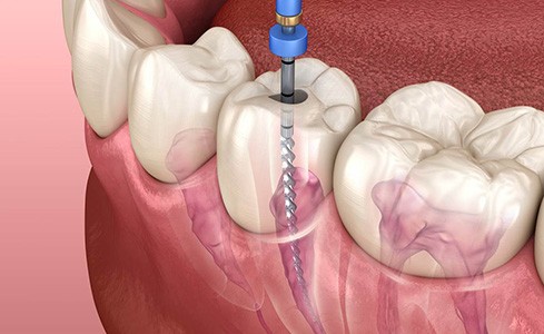 Model of healthy tooth and tooth in need of root canal therapy