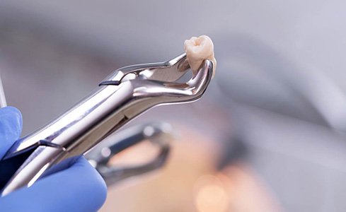 Close up of gloved hand with forceps holding extracted tooth