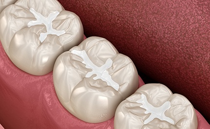 Illustration of teeth with tooth-colored fillings in Long Island City, NY