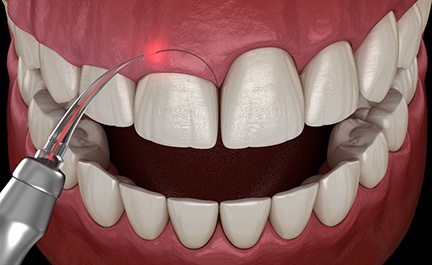Illustration of gum recontouring