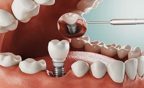 Animated smile during tooth replacement with dental implants