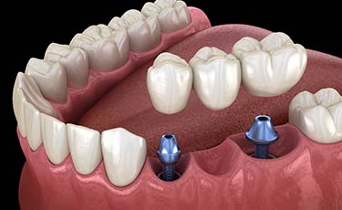 two dental implants supporting a dental bridge