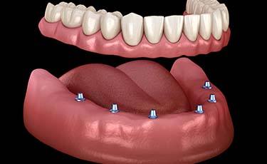 Animated smile during dental implant supported denture placement