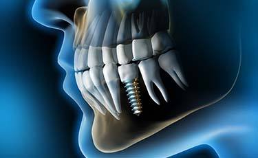Animated smile with a dental implant supported dental crown