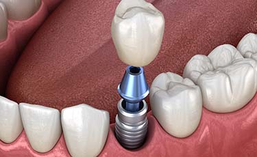 Animated smile during single dental implant supported dental crown placement