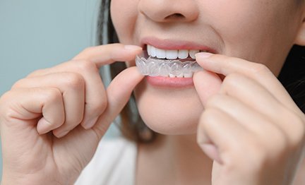 Closeup of woman putting on clear aligner