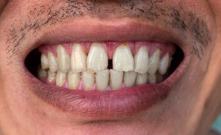 Man with gapped front teeth