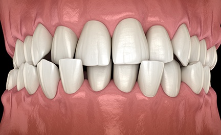 Digital illustration of underbite