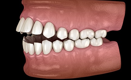 Digital illustration of open bite