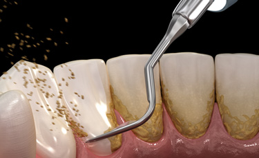 a computer illustration showing a dental scaler cleaning plaque from teeth