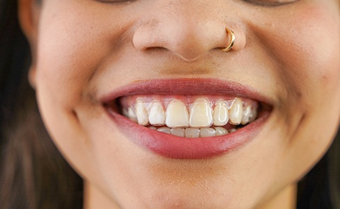 Closeup of smiling woman wearing Invisalign aligners