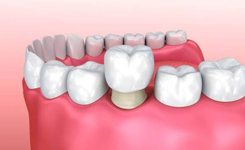 Animated smile with dental crown being fitted over tooth