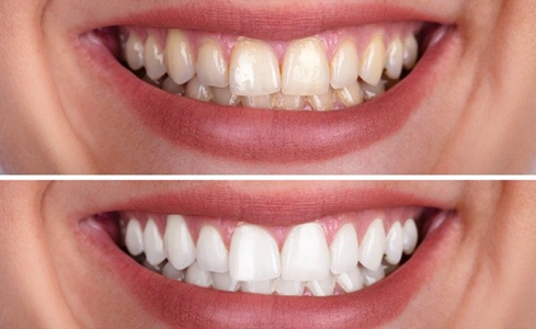 Smile before and after teeth whitening in Long Island City