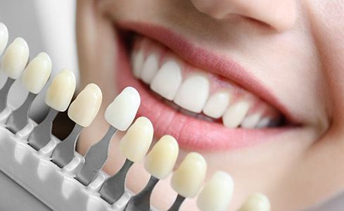 Closeup of smile compared with porcelain veneer color chart