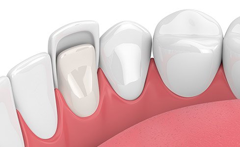 Animation of porcelain veneer placement process