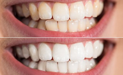 The type of stains present in your smile can affect the cost of teeth whitening