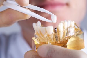 Dental implants in Long Island City replace missing teeth from root to crown. Learn the treatment process at LIC Dental Associates.