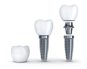 Dental Implants in Long Island City preserve jaw bone integrity.