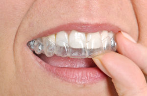 Which Is Best Invisalign In Long Island City Vs Braces