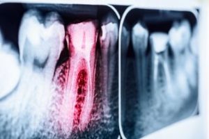 X-ray showing an infected tooth