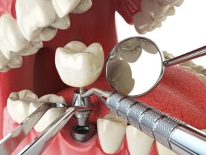 dental implant abutment and tools 