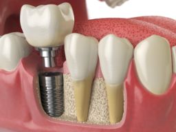 Model of an implant in the lower jaw