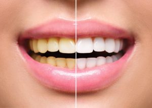 Discolored smile before and after visiting Long Island City dentist