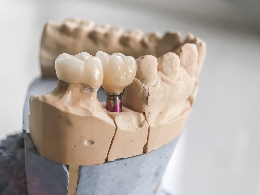 Dental implant and crown in model of lower jaw