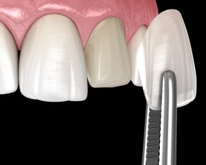 veneers 3D illustration 