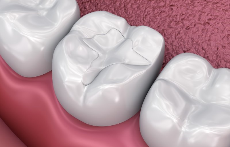 how long does a glass ionomer filling last