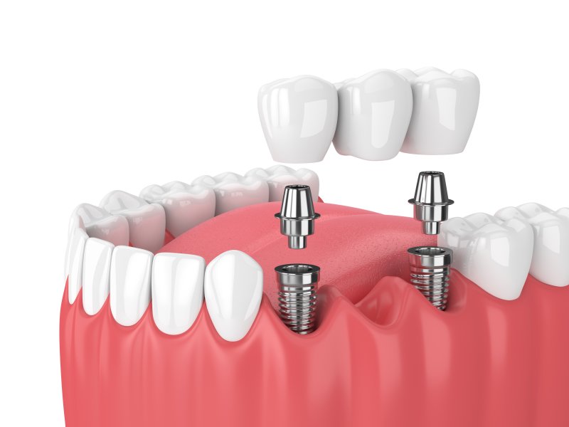 Illustration of dental bridge