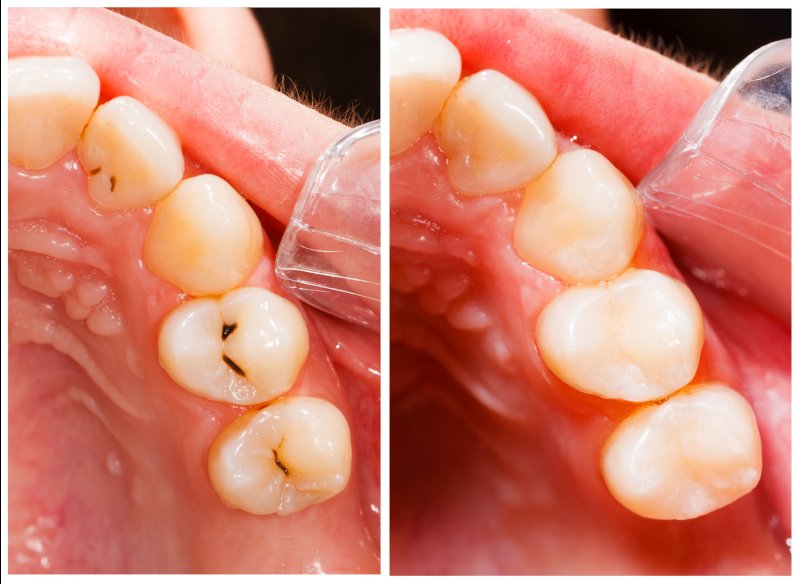 side-by-side image of cavities and dental fillings