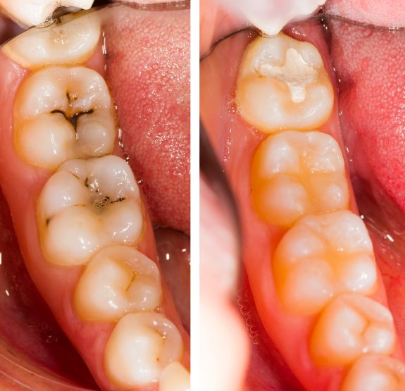 Teeth before and after composite resin fillings